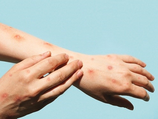 Confirmaron dos nuevos casos de viruela s&iacute;mica en la provincia