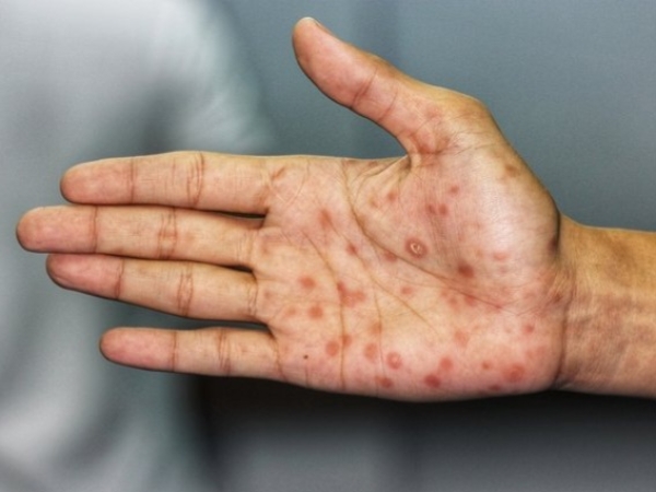 Recomendaciones ante el aumento de casos de s&iacute;filis